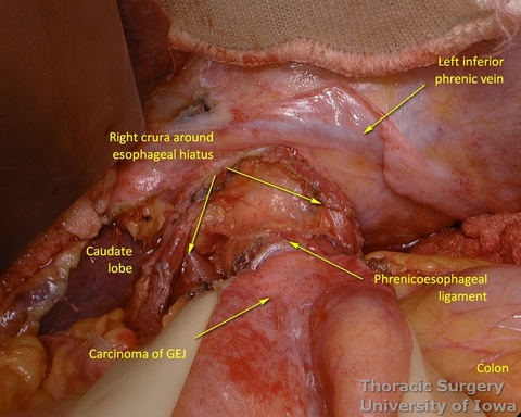 Phrenoesophageal ligament and postradiation adhesions need to be divided to enter the mediastinum
