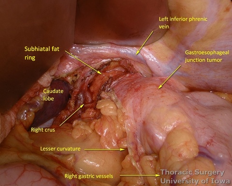 hrenoesophageal ligament is circumferentially divided to enter posterior mediastinum during esophagectomy