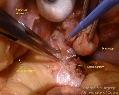 Postradiation adhesions are divided with care during posterior mobilization of the stomach 