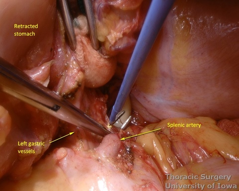 Postradiation adhesions are divided during posterior mobilization of the stomach for esophagectomy