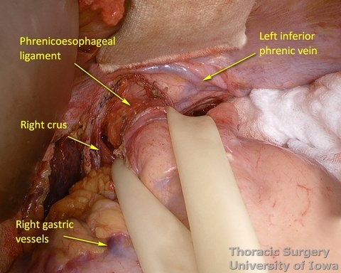 Retraction with a Penrose drain around gastroesophageal junction facilitates exposure and dissection of the hiatus