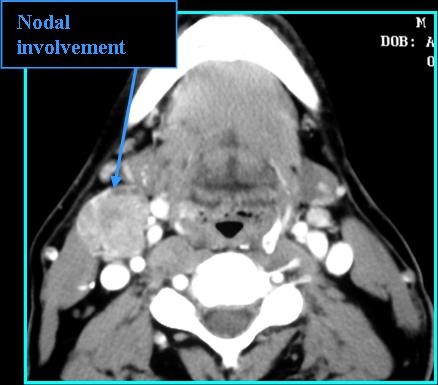 SCCaTonsilNode_CT_0715.jpg SCCaTonsilNode_CT_0715