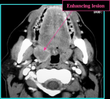 SCCaTonsil_CT_0715.jpg SCCaTonsil_CT_0715