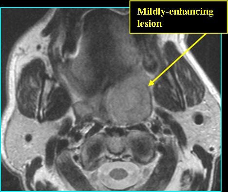 SCCaTonsil_T2_0715.jpg SCCaTonsil_T2_0715