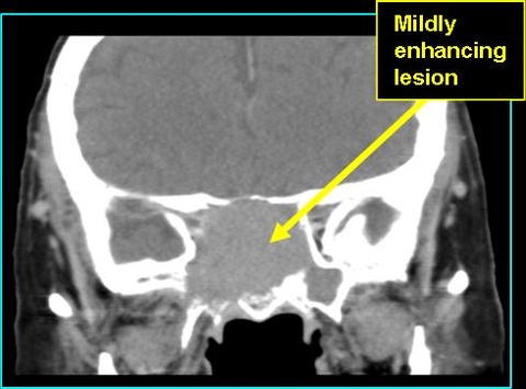 SNlymph_CT_0803