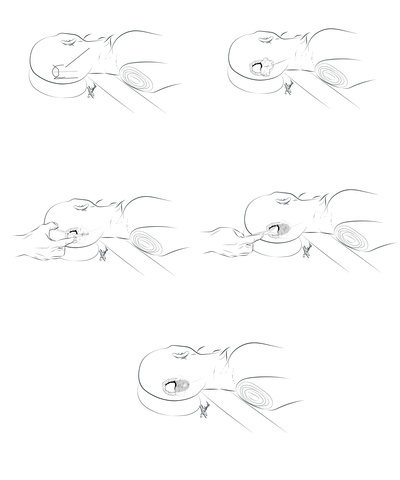 Shunt Scissors Sequence.jpg Shunt Scissors Sequence