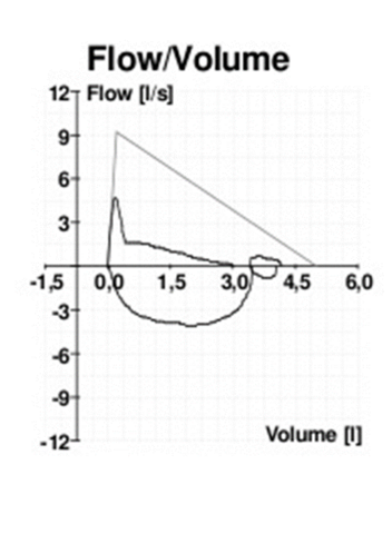 Flow volume loop in a patient with COPD demonstrating impaired inhalation. Image obtained from http://commons.wikimedia.org/wiki/File:COPD.png.