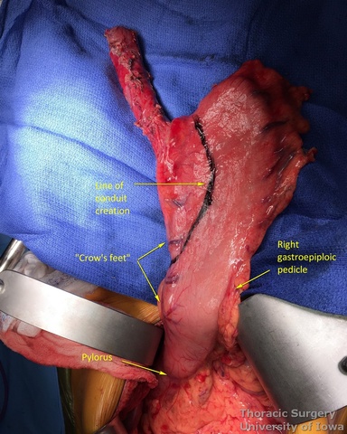 Stomach and thoracic esophagus are delivered out of the abdomen_Line of gastric division is makked edit lable