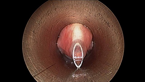 TEP_needle TEP_needle