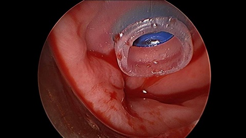 TEP_prosthesis