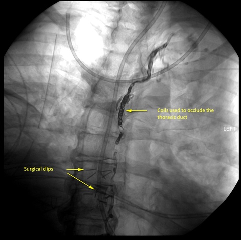 Thoracic duct ligation for chylothorax failed in an outside institution and successful IR embolization