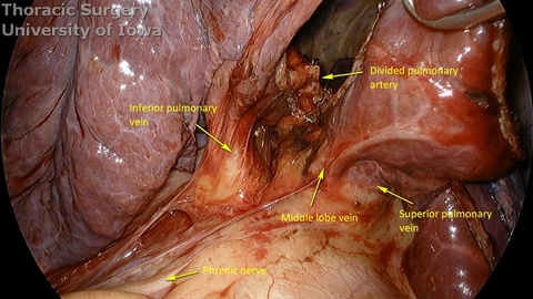 Thoracoscopic minimally invasive VATS lung resection lobectomy for lung carcinoma right lower lobectomy pulmonary artery divided with anatomy shown