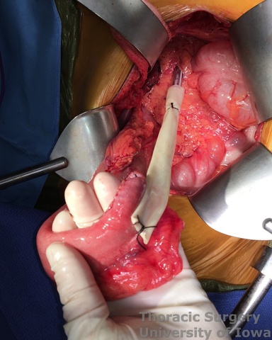 Transhiatal Esophagectomy for carcinoma Saratoga Sump used to deliver the conduit from the abdomen into neck incision Transhiatal Esophagectomy for carcinoma Saratoga Sump used to deliver the conduit from the abdomen into neck incision