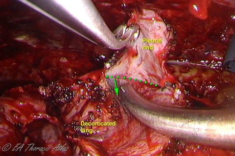 VATS decortication. Note the small amplitude of movement of the suction (green arrow) very close to the rind lung interface (dotted green line)