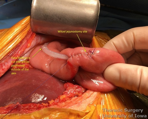 Witzel jejunostomy is placed 20 cm distal to ligament of Treitz