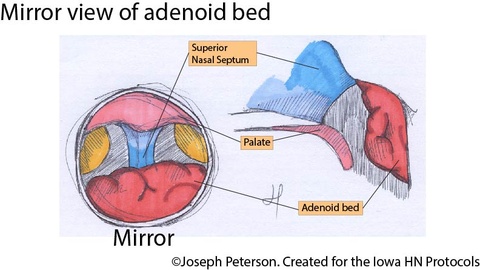 adenoid mirror