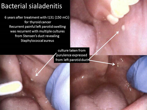 composite parotid massage bacterial sialadenitis .png composite parotid massage bacterial sialadenitis