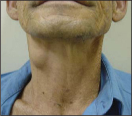 external%20laryngocele.jpg external%20laryngocele
