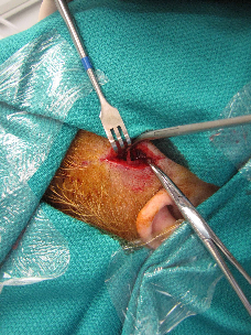 grace renee temporal artery biopsy grace renee temporal artery biopsy