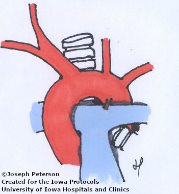 innominate arteryc