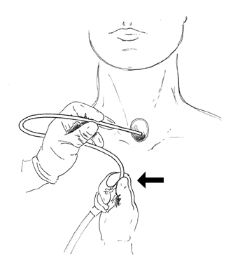 larygectomy04_0.gif