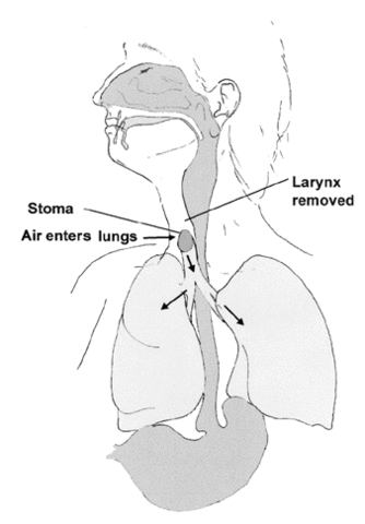 laryngectomy02_0.gif