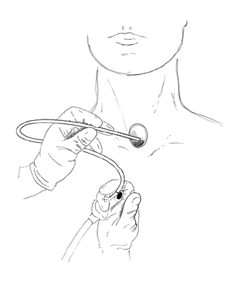 laryngectomy03.gif