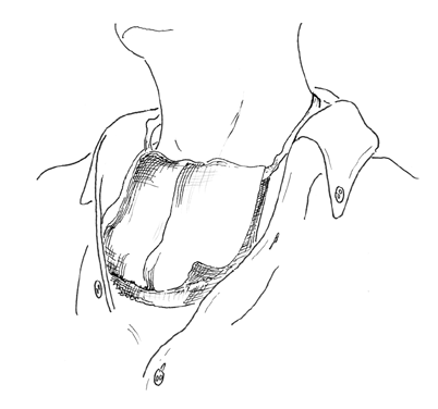 laryngectomy05_0.gif