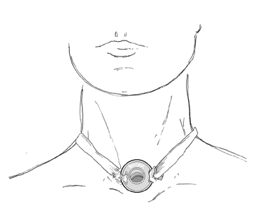 laryngectomy06.gif