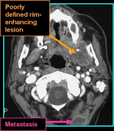 liposarc_CT_0727