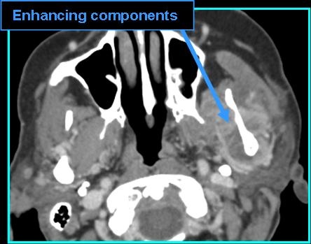 osteosarc_CT_0727