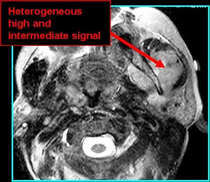 osteosarc_T2_0727