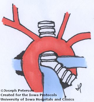 pulmonary slingc