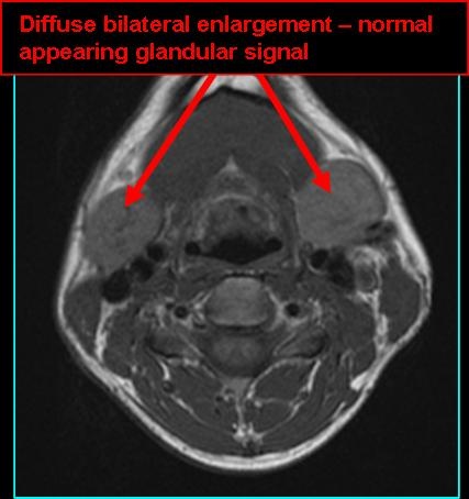 sialosis_T1_0721.jpg sialosis_T1_0721