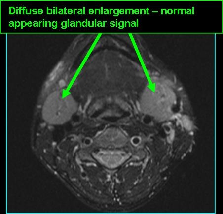 sialosis_T2_0721.jpg sialosis_T2_0721