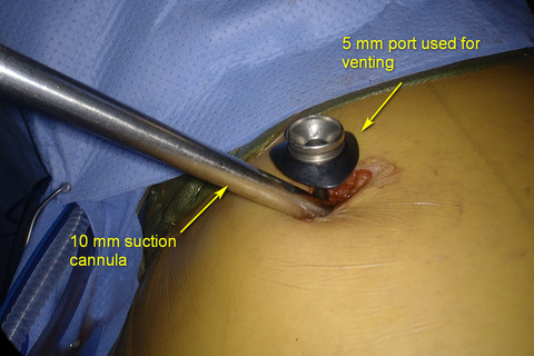Venting cannula placed along the camera, or instruments may avoid suction effect during VATS cases