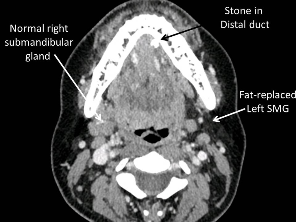 Salivary Gland Atrophy with Chronic Obstruction | Iowa Head and Neck ...