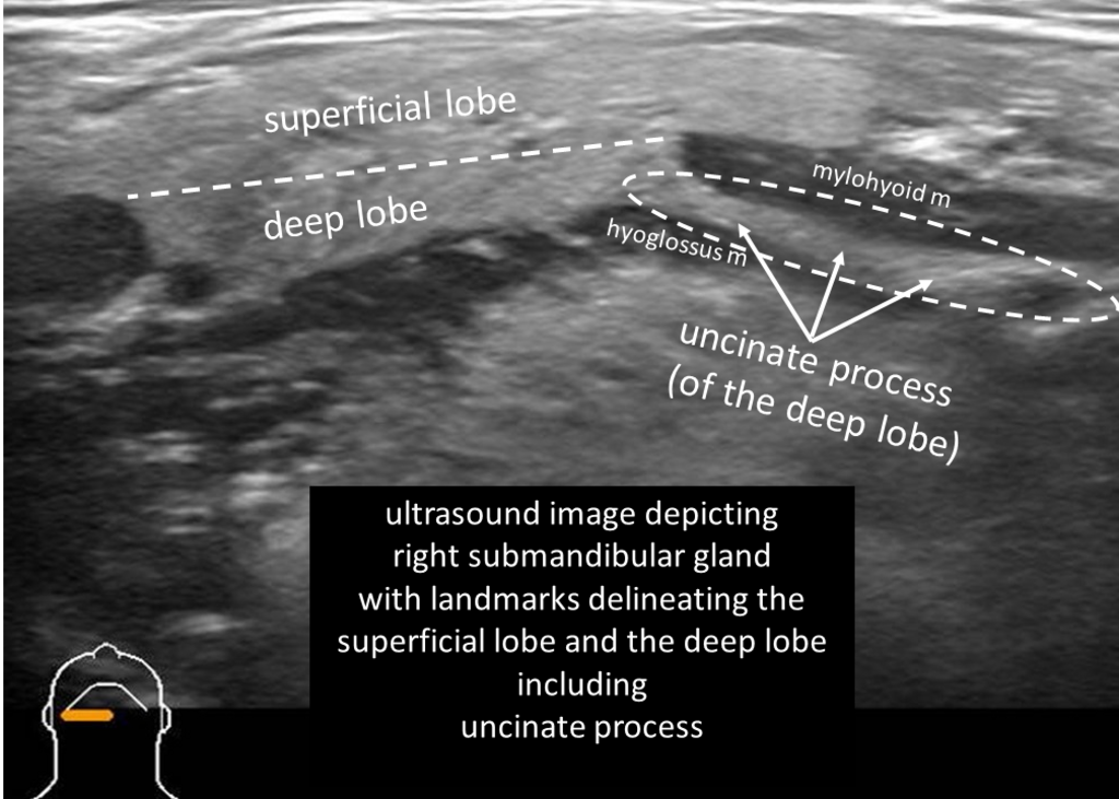 Submandibular Gland Anatomy: The Uncinate Process of the Deep Lobe ...