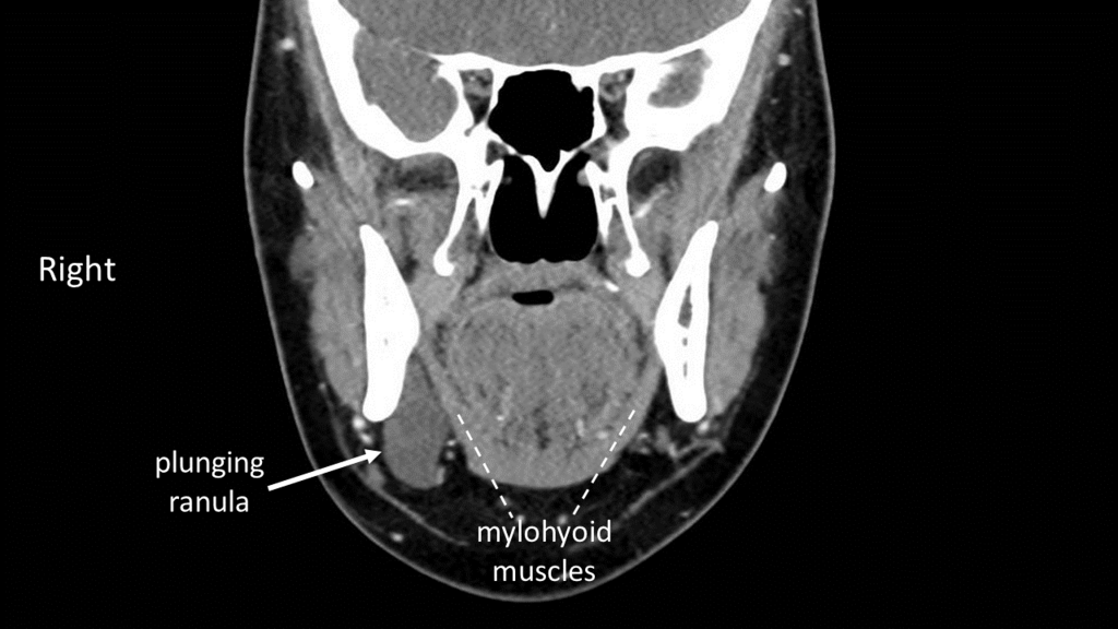 Submandibular Gland Anatomy: The Uncinate Process of the Deep Lobe ...