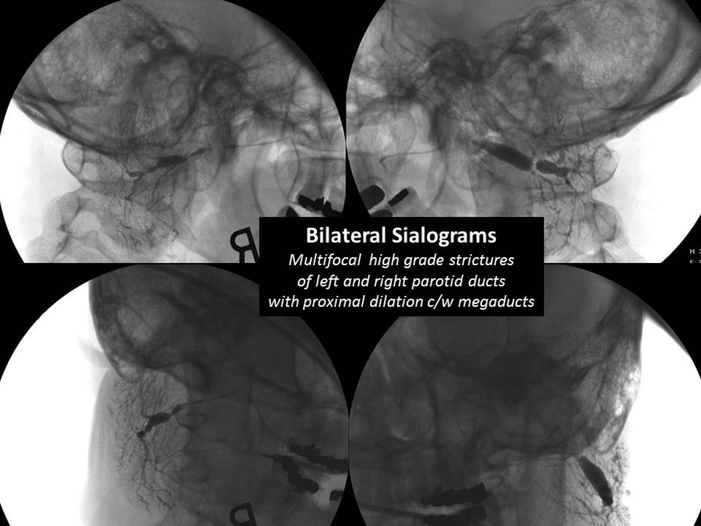 Parotid Duct Stricture Dilation with Salivary Balloon and Ultrasound ...