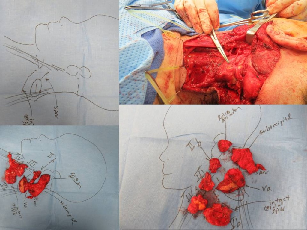 Posterolateral Neck Dissection Variant of Trapezius Innervation | Iowa ...