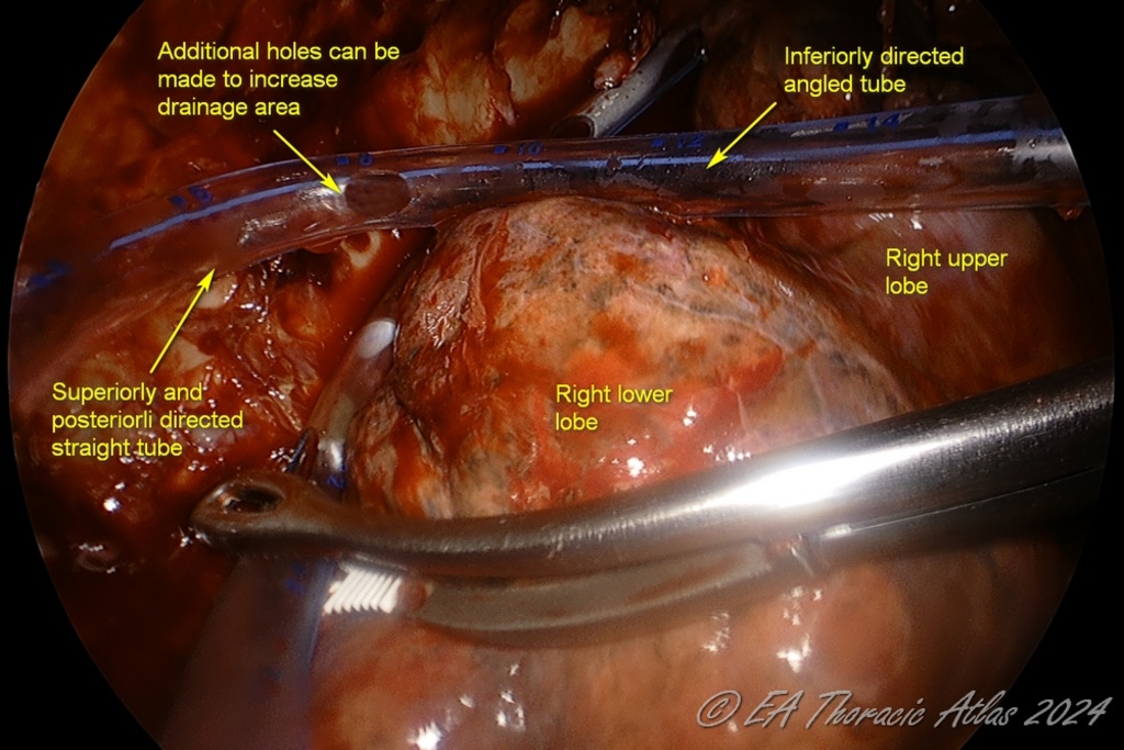 After completion of the empyema evacuation and decortication chest tubes are positioned to widely drain the pleural space