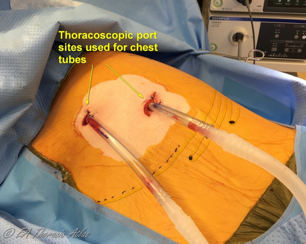 Two port are sufficient for VATS decortication in most cases of empyema and can be used as postoperative chest tube sites