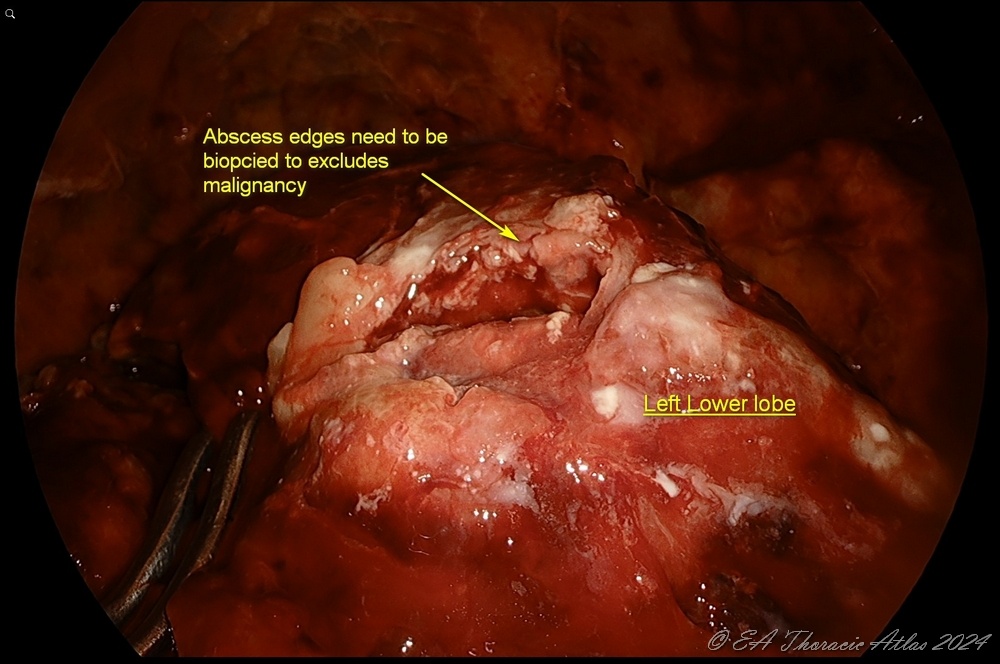 Edges of peripheral lung abscesses should be biopsied to rule out malignancy during thoracoscopic (VATS) empyema drainage and decortication