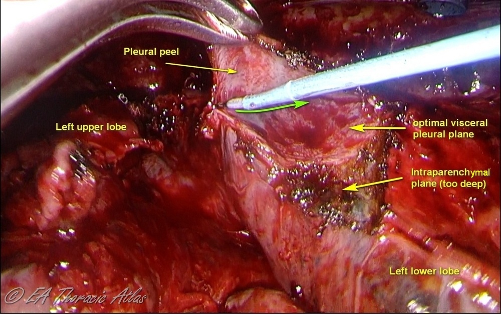 Electrocautery can be used for thoracoscopic (VATS) decoration if the rind is densely adherent to the lung with care to stay in the optimal plane of dissection