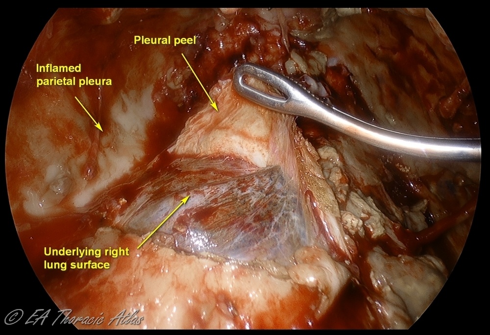 Empyema Stage III (fibrous phase) with thick rind covering lung and preventing its reexpansion