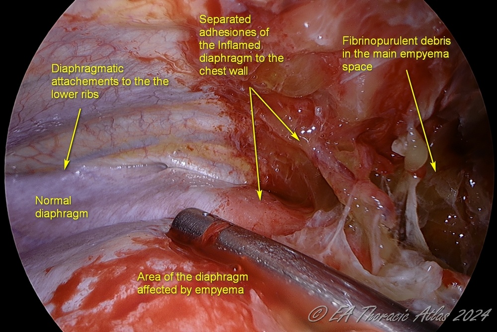 Entire diaphragm needs to be mobilized up all the way to its rib attachments