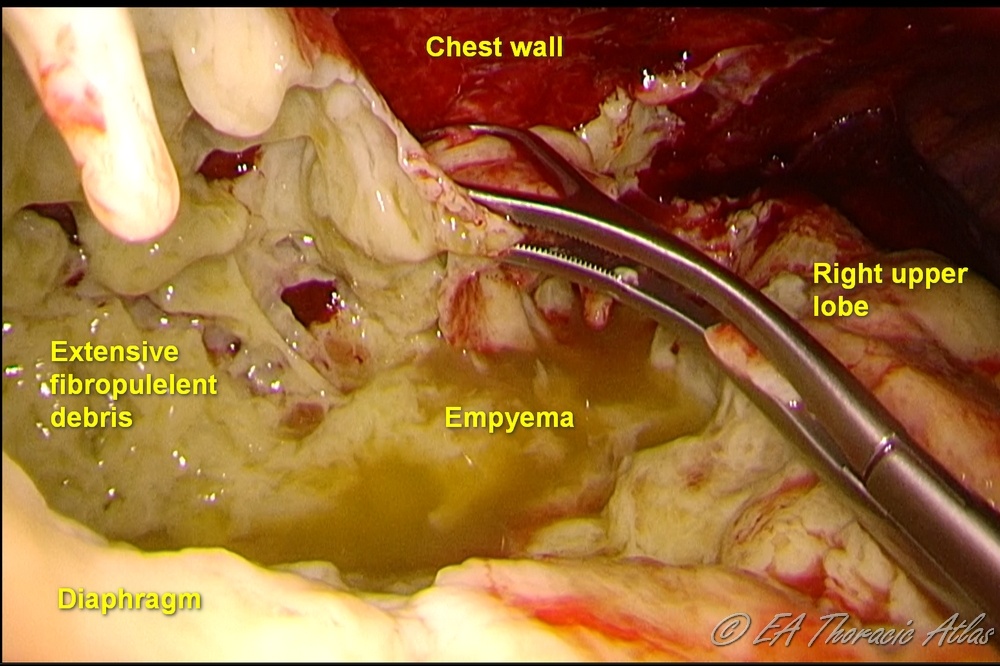 Fibrinopurulent debris on chest wall is  removed  the as a part of VATS decortication for an empyema
