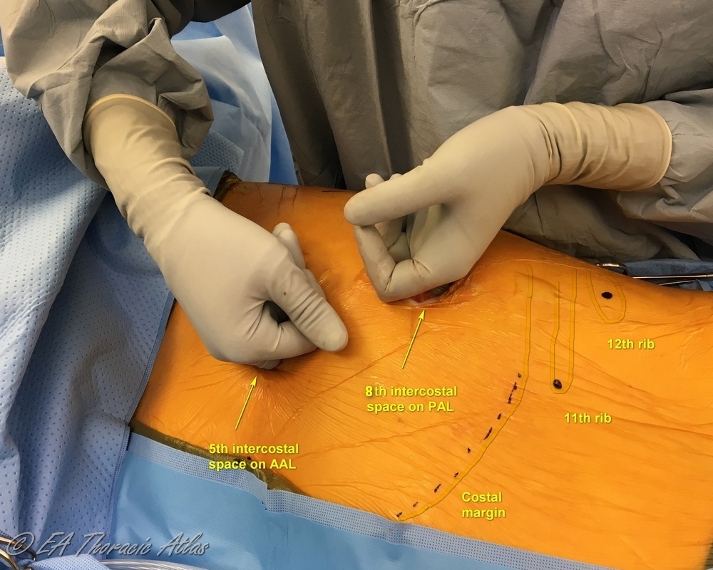 Initial creation of the working space for VATS decortication using simultaneous two finger dissection of  the lung from the chest wall