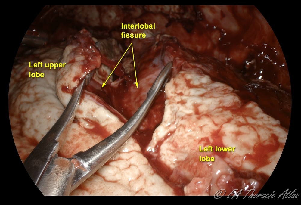 Interlobar fissure needs to be identified and mobilized during VATS complicated effusion or empyema drainage and decortication to maximize lung expansion